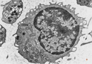 F,50y. | blood … lymphocyte and thrombocyte